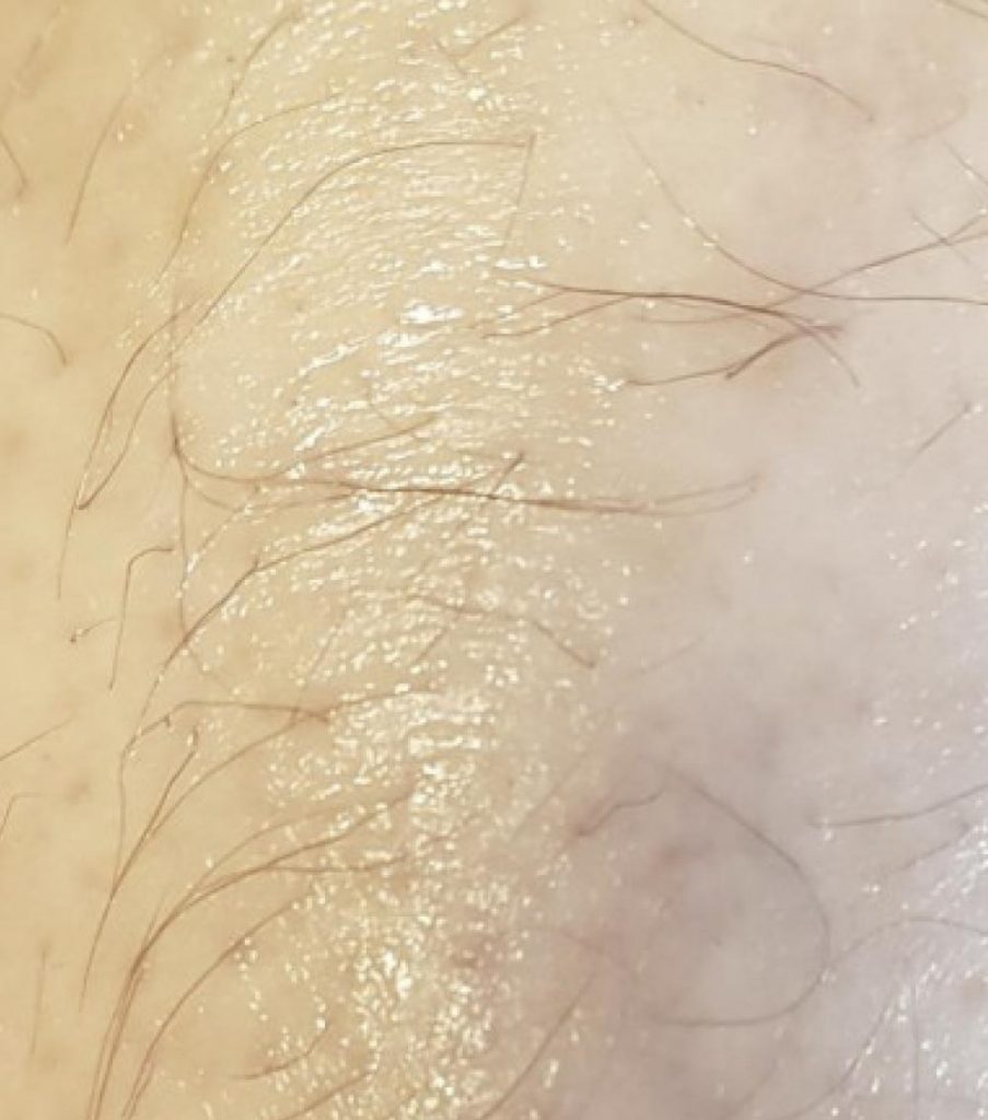 Ekzem nach der Behandlung mit Aloe vera