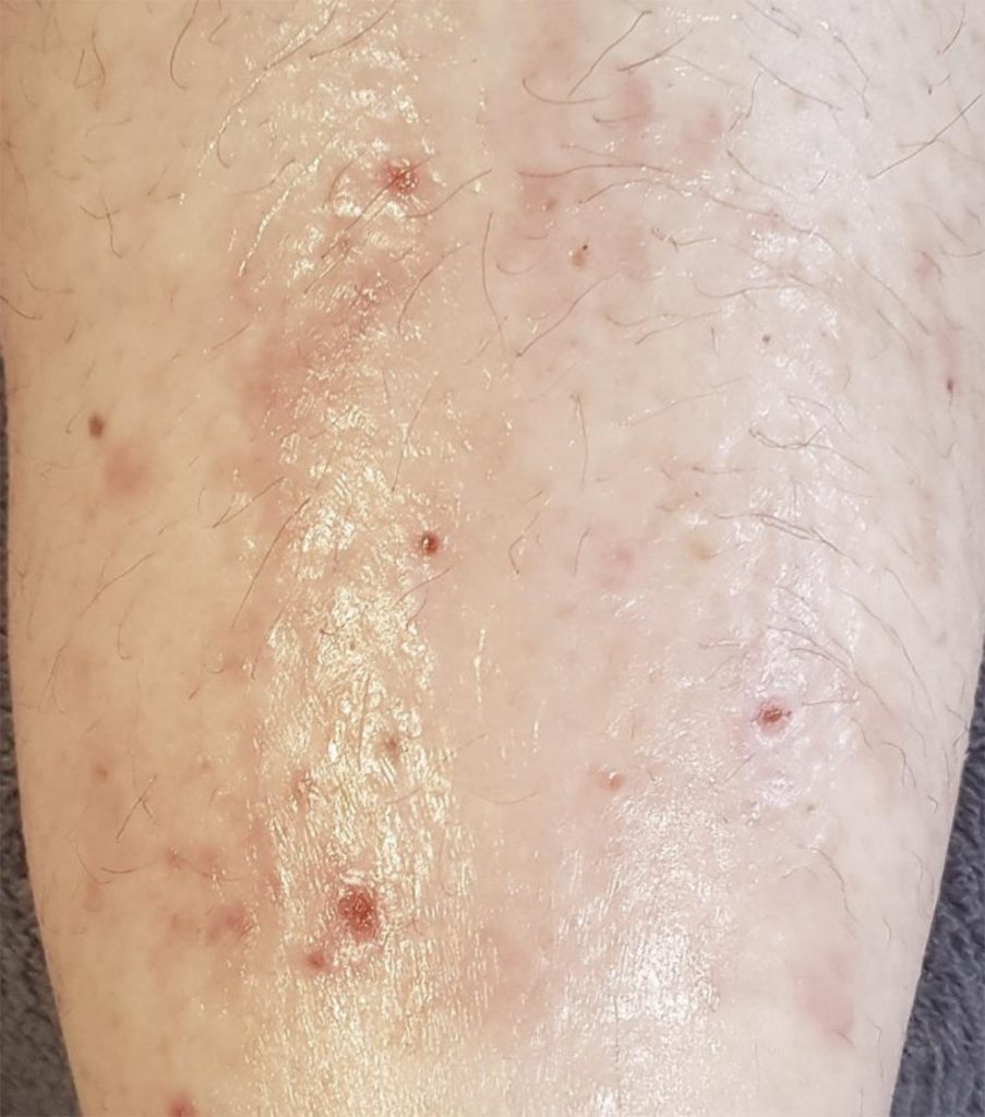Ekzem vor der Behandlung mit Aloe vera