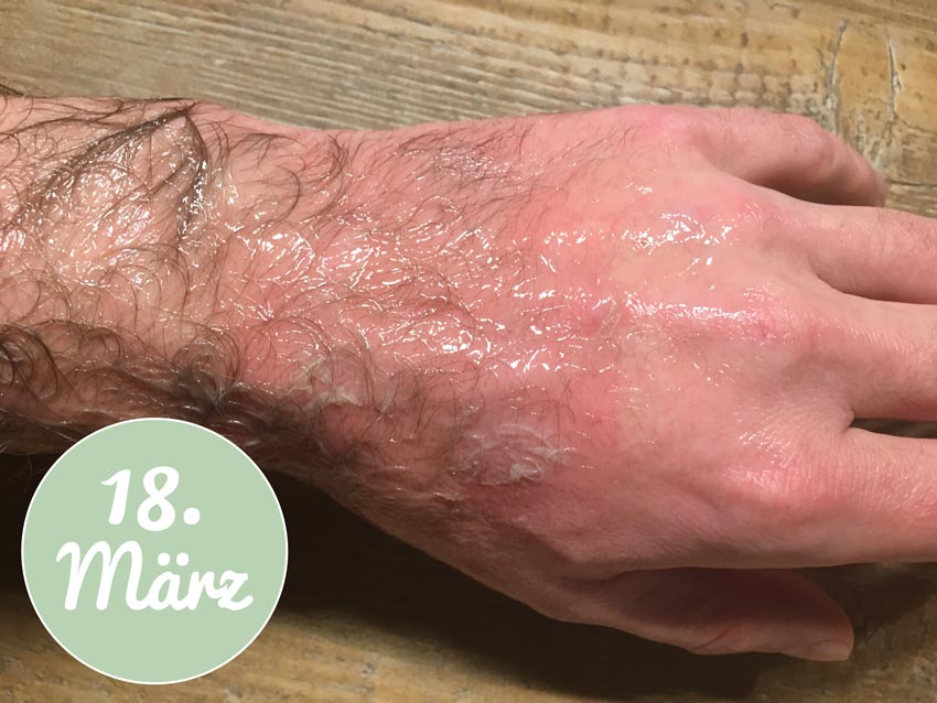 Aloe vera Gel bei Verbrennungen 18. März