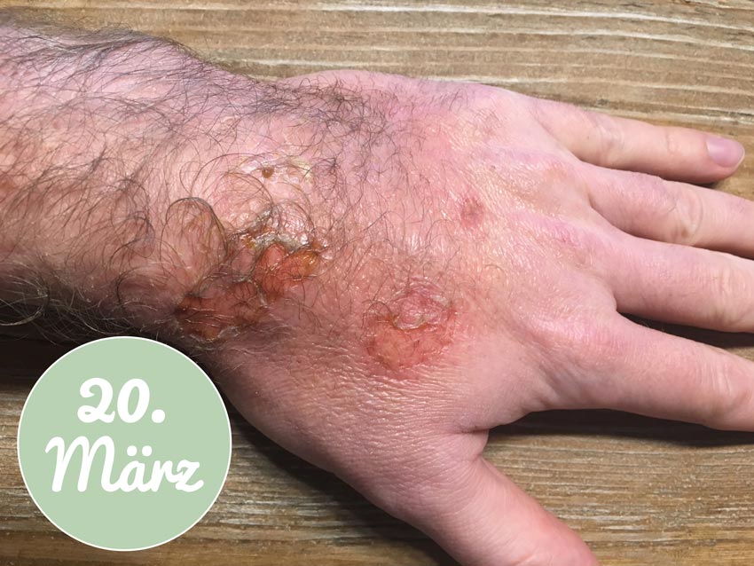 Meine Hand am 20. März