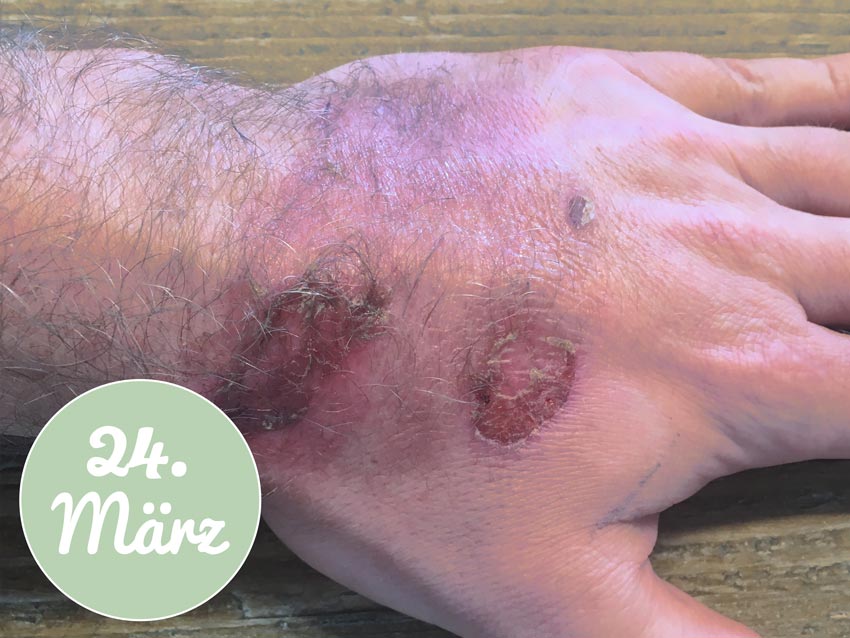 Meine Hand am 24. März - Behandlung mit Aloe vera Gel