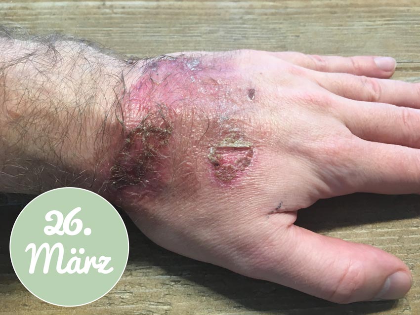 Nach der Versorgung mit Aloe vera Gel am 26. März