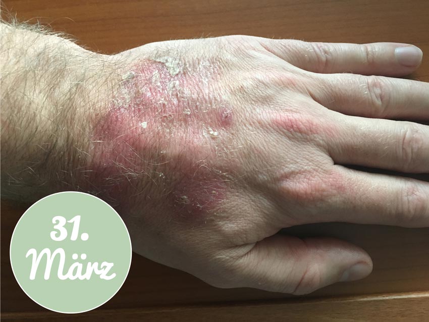 Behandlung mit Aloe vera am 31. März
