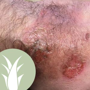 Aloe vera Gel bei Verbrennungen - Erfahrungsbericht